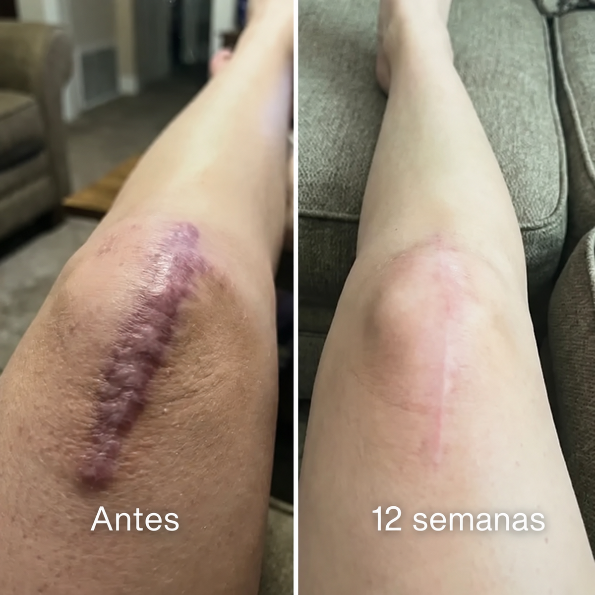 Claréa™ - Stick para cicatrices de acné